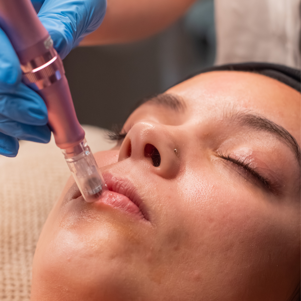 EXOSOMAS CON DERMAPEN FACIAL, SPA CALMA, VILLA MARIA